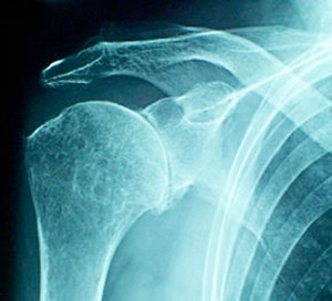 Shoulder X-ray showing arthritis