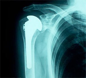 Shoulder X-ray after a shoulder replacement
