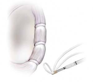 Illustration of a labrum repair in the shoulder