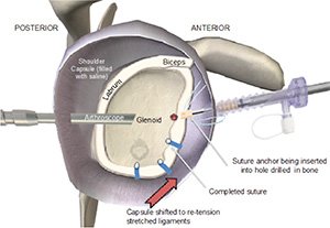 Diagram of an arthroscopic shoulder stabilisation with suture anchors