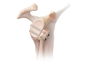 Illustration of a shoulder stabilisation with screws (Latarjet procedure)