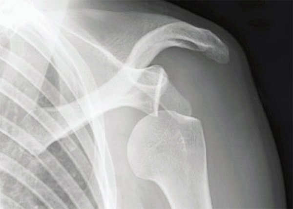X-ray image of glenohumeral (GH) dislocation.